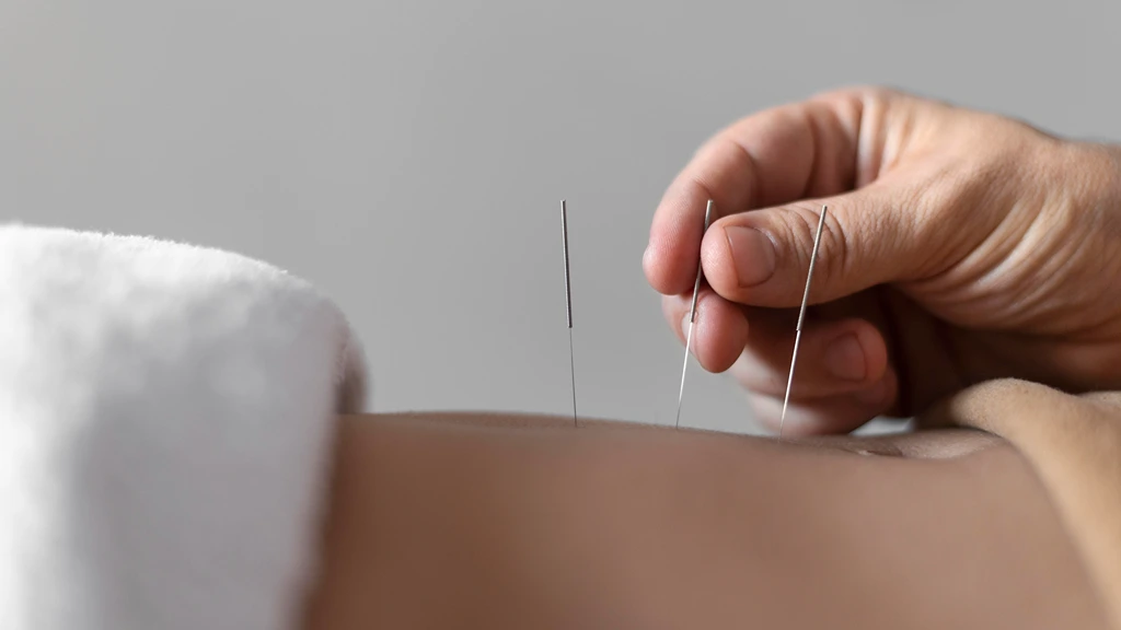 Most Popular Alternative Medicine in Indonesia Acupuncture