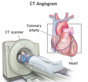 A CT angiogram allows your healthcare provider to see your heart blood vessels and tissues