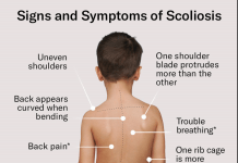 Scoliosis in Children