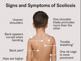 Scoliosis in Children